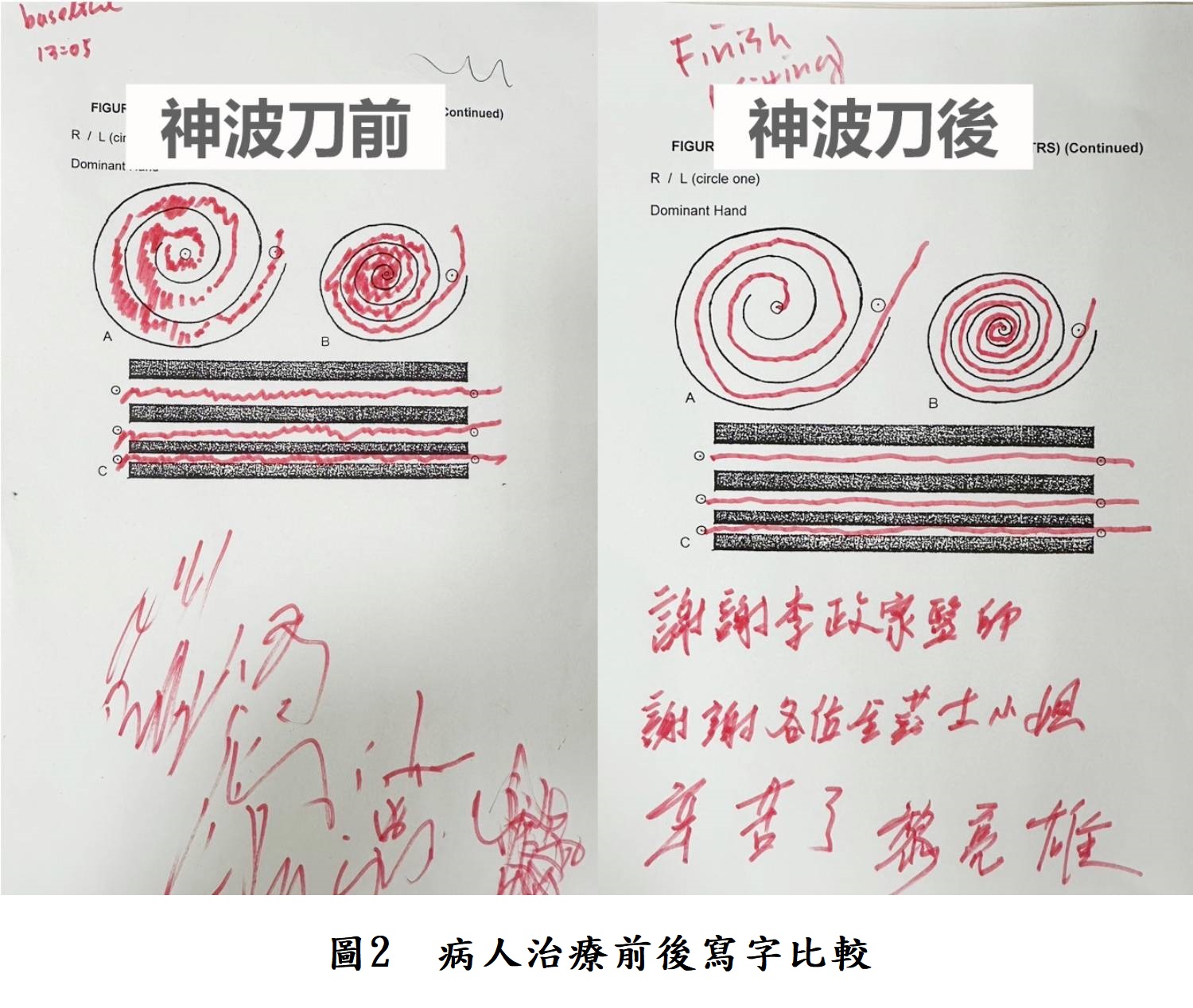 圖2  病人治療前後寫字比較